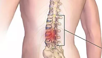 Pinched-Nerve-Anatomy Pinched-Nerve-Anatomy